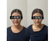ルピナス 立川店/大人気の脂肪撃退アンプル