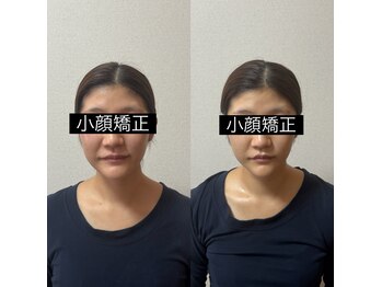 ルピナス 立川店/大人気の脂肪撃退アンプル