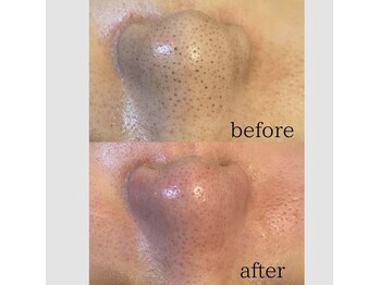 毛穴専科/韓国式4D毛穴洗浄+白玉wax