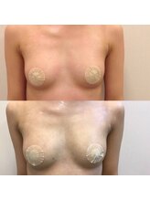 ベッピン(Beppin)/バストアップ症例写真