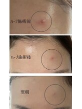 トゥモロー(TOMORROW)/ハーブピーリング/肌質改善