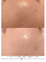 デコアイ(Deco eye)/30代女性　毛穴