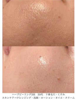 デコアイ(Deco eye)/30代女性 毛穴