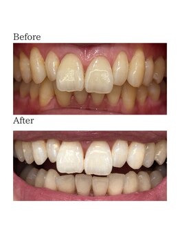 ノーブル 上土店(Noble)/ホワイトニングBeforeAfter