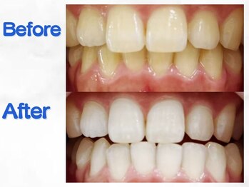 LBSホワイトニング 梅田店/ホワイトニングビフォーアフター