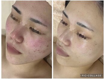 リンダ(Rinda)の写真/繰り返さない毛穴悩み特化◎毛穴開き/詰まり/黒ずみ/皮脂根本ケア◎天然ハーブピーリリング×韓国肌管理