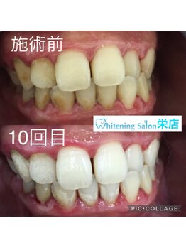 ホワイトニングサロン 名古屋 栄店/【ホワイトニング施術例】