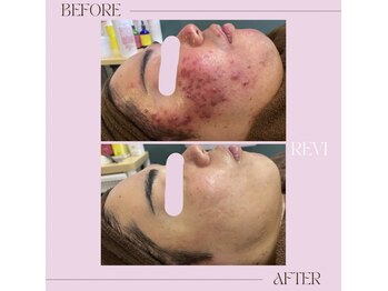 ホワイトラボ ライカム前店(White labo)/肌質改善☆REVIハーブピーリング