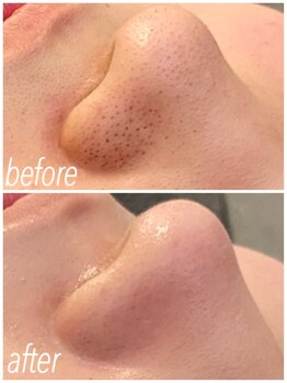 シス(SiS)/ハイドラ/いちご鼻改善