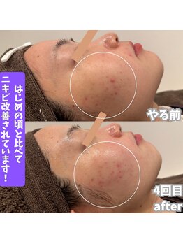 ビアル(VIALU)/カーボキシー１ヶ月短期集中ケア