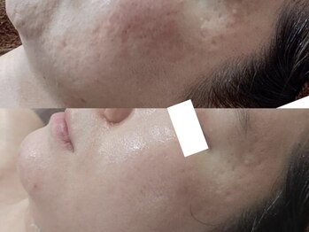 ミルジュ(MiLuJu)/ハーブピーリング/ニキビケア