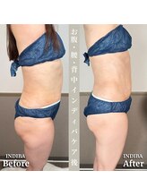 術後の女神 大阪心斎橋店/術後ケアインディバ・インディバ