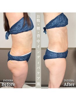術後の女神 大阪心斎橋店/術後ケアインディバ・インディバ