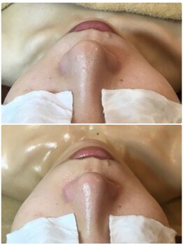 叶(Kanau)/毛穴エクストラクション1回