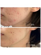 ミドリ(MIDORI)/繰り返すニキビ徹底ケア症例4-1