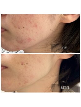 ミドリ(MIDORI)/繰り返すニキビ徹底ケア症例4-1