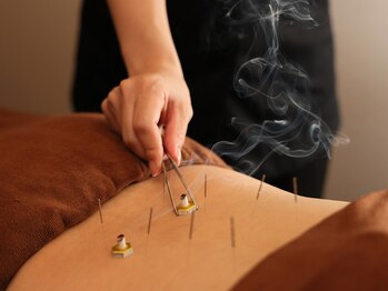 ハリラックス(HA:Ri/LAX)/【身体鍼灸の様子】