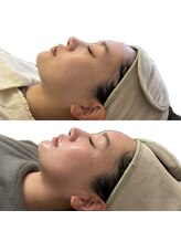 彌庵/ふっくらまんまるおでこ形成