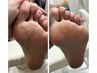 足裏の角質除去付き！フットケア☆角質除去のみは￥4,400