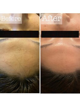 パウザ(PAUSA)/ハーブピーリング