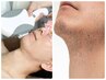 男性限定脱毛♪★ひげの部位のみ★　頬部位含みOK！※ご来店前に髭剃り必要※