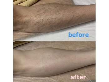 エーディーラボ(A.D LABO)/脱毛☆before & afterになります