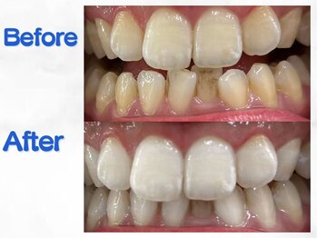LBSホワイトニング 梅田店/ホワイトニングビフォーアフター