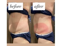 ビュウナ 銀座(BEAUNA)/脂肪冷却/frozen8