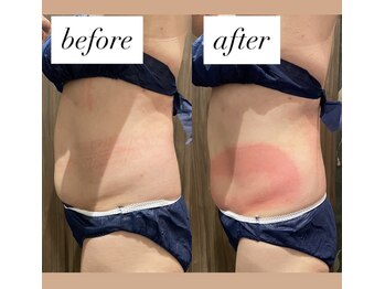 ビュウナ 銀座(BEAUNA)/脂肪冷却/frozen8