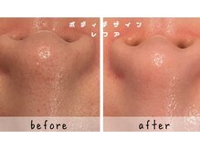 レフアの雰囲気（毛穴汚れは、黒ずみもいちご鼻も改善する毛穴洗浄コースがすごい）