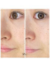 プルクレ 常磐町店(Pulchre)/10日間の肌変化♪