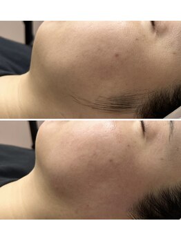 ホワイトワックス 京都四条烏丸(WHITE WAX)/《全顔》フェイシャルワックス