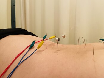 ジェイペック鍼灸整骨院/鍼灸施術【肩こり・腰痛に】