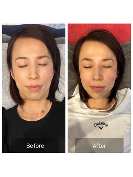 プライミー(PRIMY)/小顔矯正でマリオネット撃退