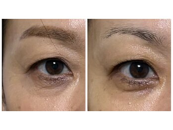 スーコ(SU:CO)/糸リフト ビフォー/アフター