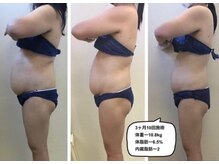 プロラボスパ 渋谷店/30代後半　痩身症例