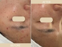 エクラ(eclat)/施術回数：7回