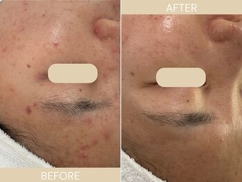 エクラ(eclat)/施術回数:7回