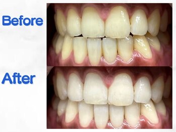 LBSホワイトニング 梅田店/ホワイトニングビフォーアフター