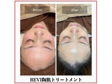 ラナン パラフューズ(Ranun's PARAFUSE.)の雰囲気（REVIハーブピーリングで毛穴ケア☆しみ/くすみ/黒ずみ）