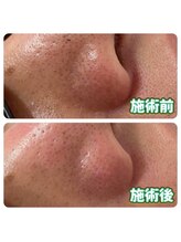 ウェルビーイング(well-being)/毛穴改善フルコース