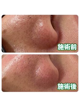 ウェルビーイング(well-being)/毛穴改善フルコース