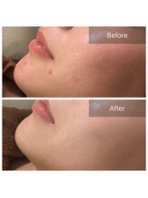 毛穴屋/ハーブピーリングで肌質改善◎