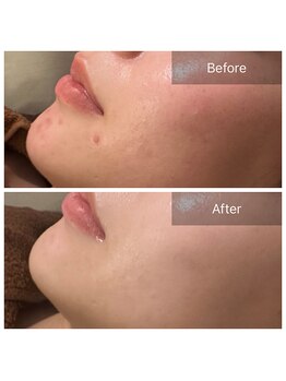 毛穴屋/ハーブピーリングで肌質改善◎