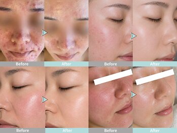 ルミナス(Luminous)の写真/全ての肌質に合うケアで毛穴と赤みを鎮静。水分チャージでプルプル肌へ導く第一歩♪