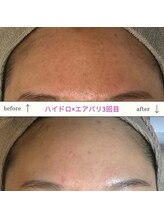 キュオバイアンドリープ(Qo by &LEAP)/ハイドロピーリング×エアバリ