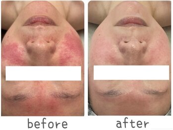 トモズサロン28(Tomos.salon.)/赤み、酒さ改善！