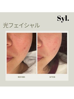 シール(Syl)/光フェイシャル