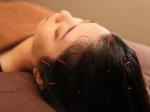 ハリラックス(HA:Ri/LAX)/【美容鍼灸の様子】