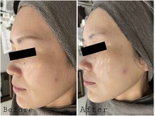 レイズ(RAISE)/目指せ韓流肌！透明水光ピール